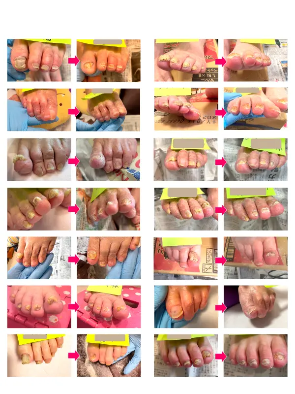 肥厚爪ケア施術ビフォーアフターの画像まとめ