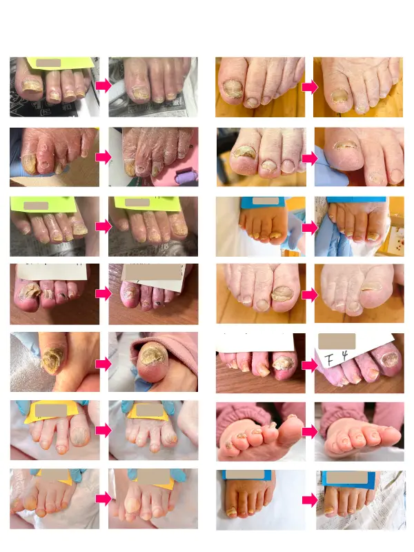 肥厚爪ケア施術ビフォーアフターの画像まとめ