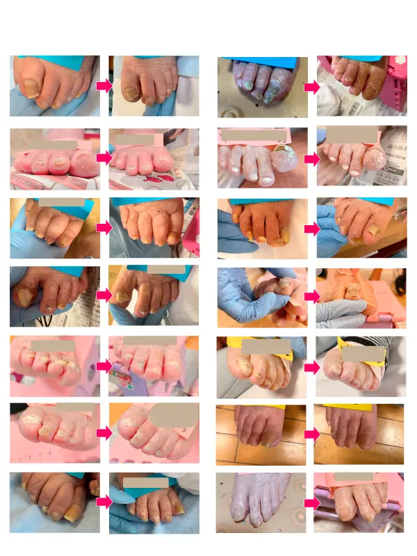 肥厚爪ケア施術ビフォーアフターの画像まとめ