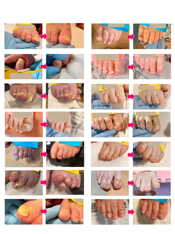 肥厚爪ケア施術ビフォーアフターの画像まとめ